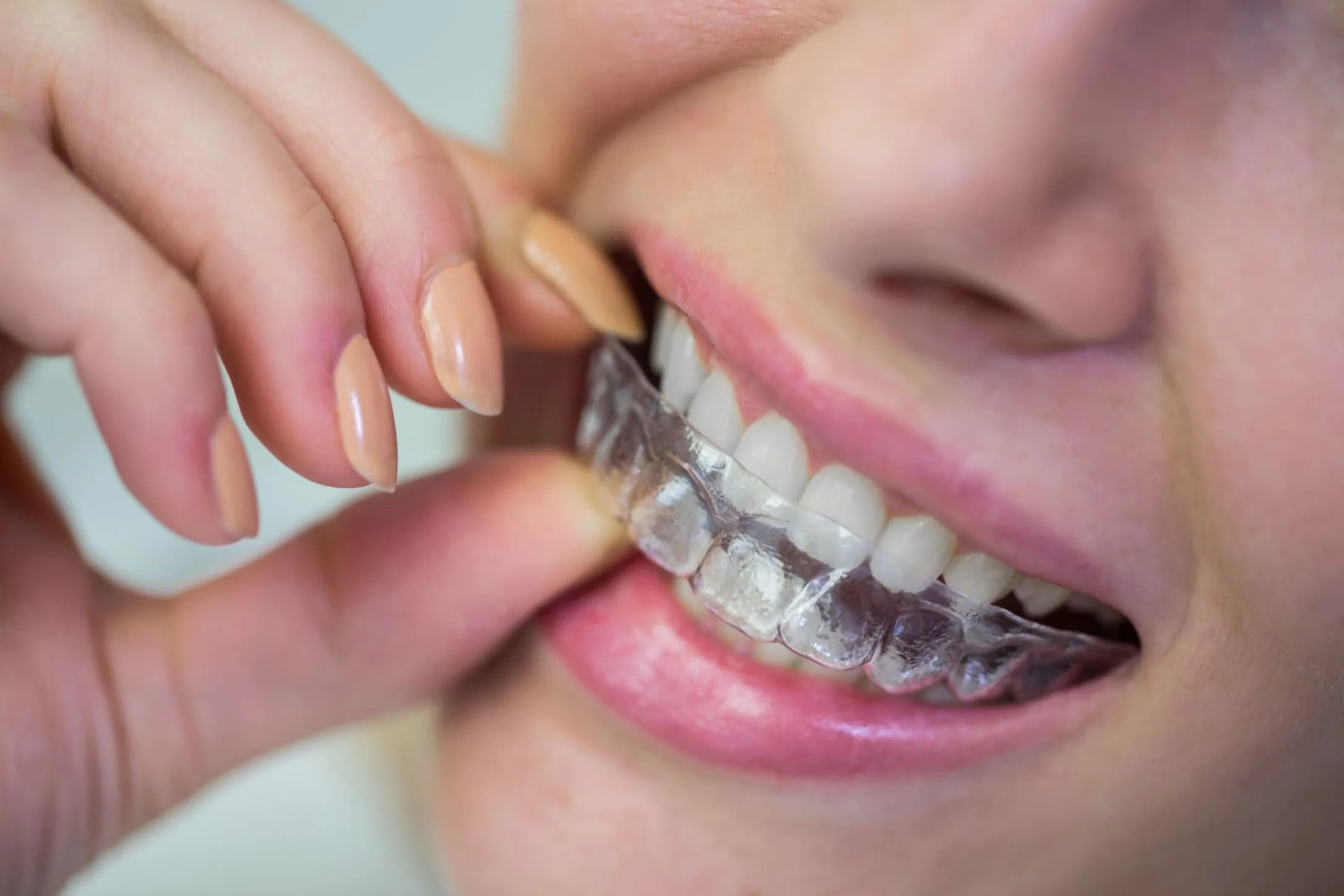 Invisalign In New Iberia, LA