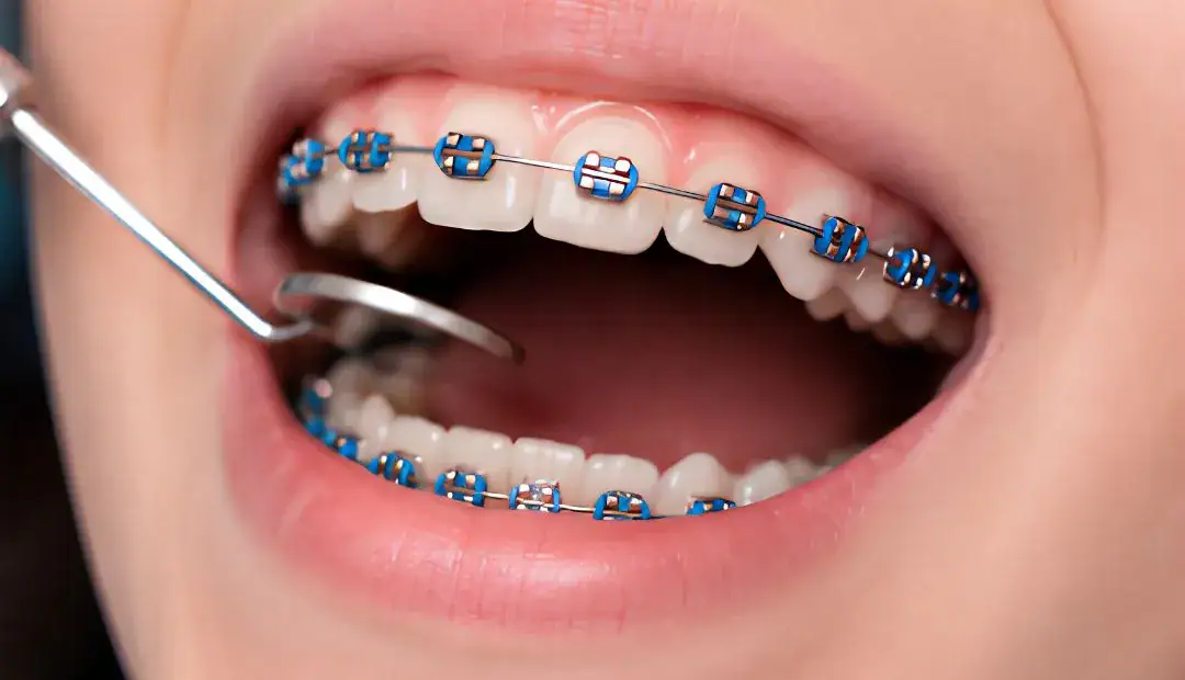 How Much Do Braces Cost for Kids 