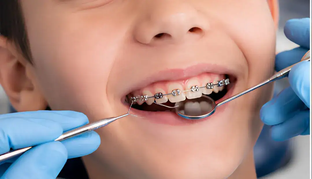 How Much Do Braces Cost for Kids 