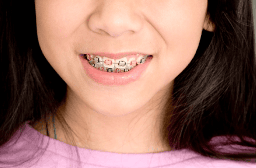 Why Are Braces So Expensive?