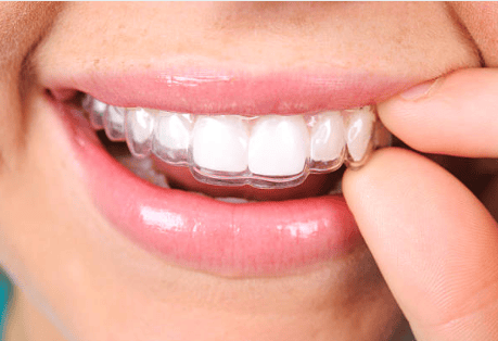 Invisalign for braces
