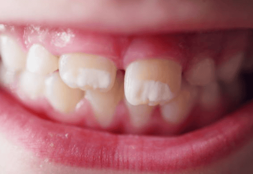 How To Remove White Spots On Teeth?