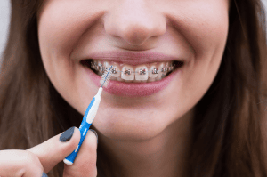 Wear Dental Braces?