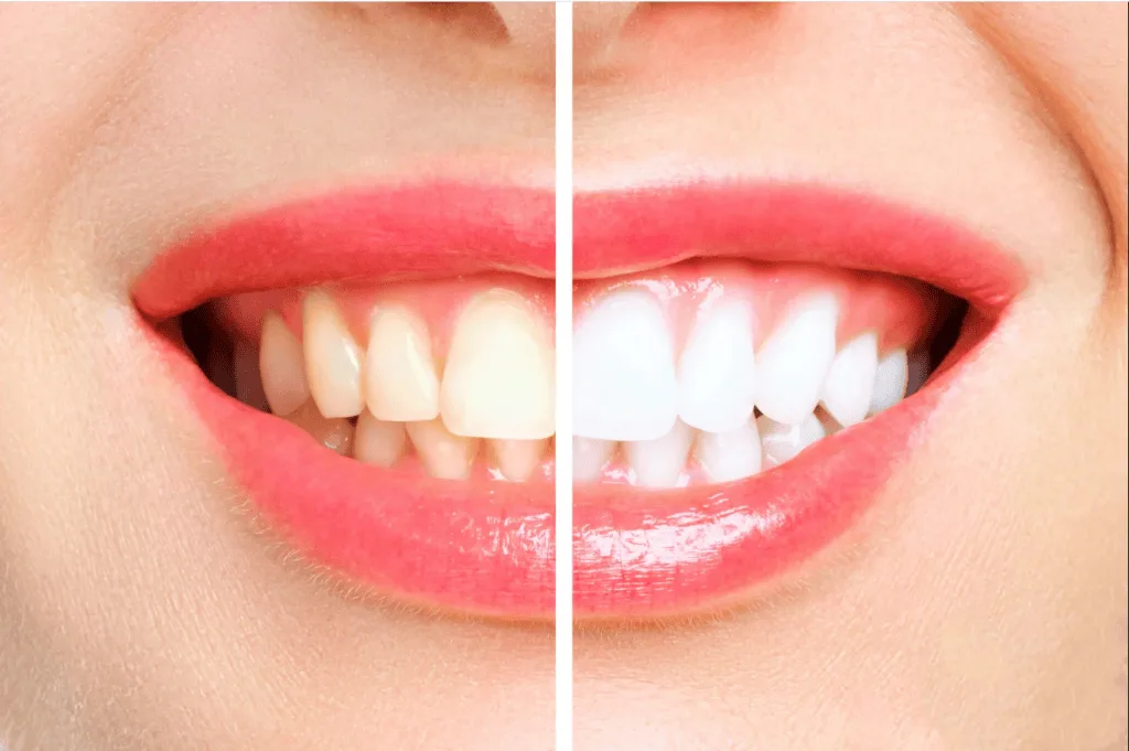 Removing White Spots