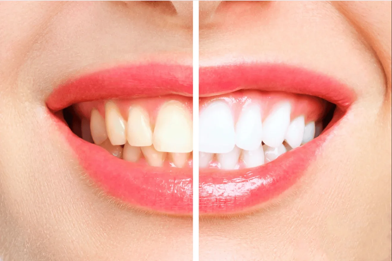 Removing White Spots