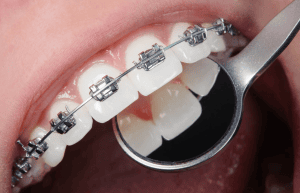 First Orthodontic Visit in New Orleans?