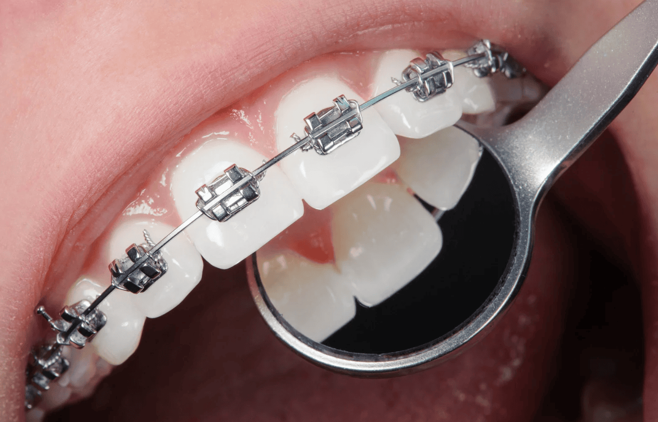 First Orthodontic Visit in New Orleans?