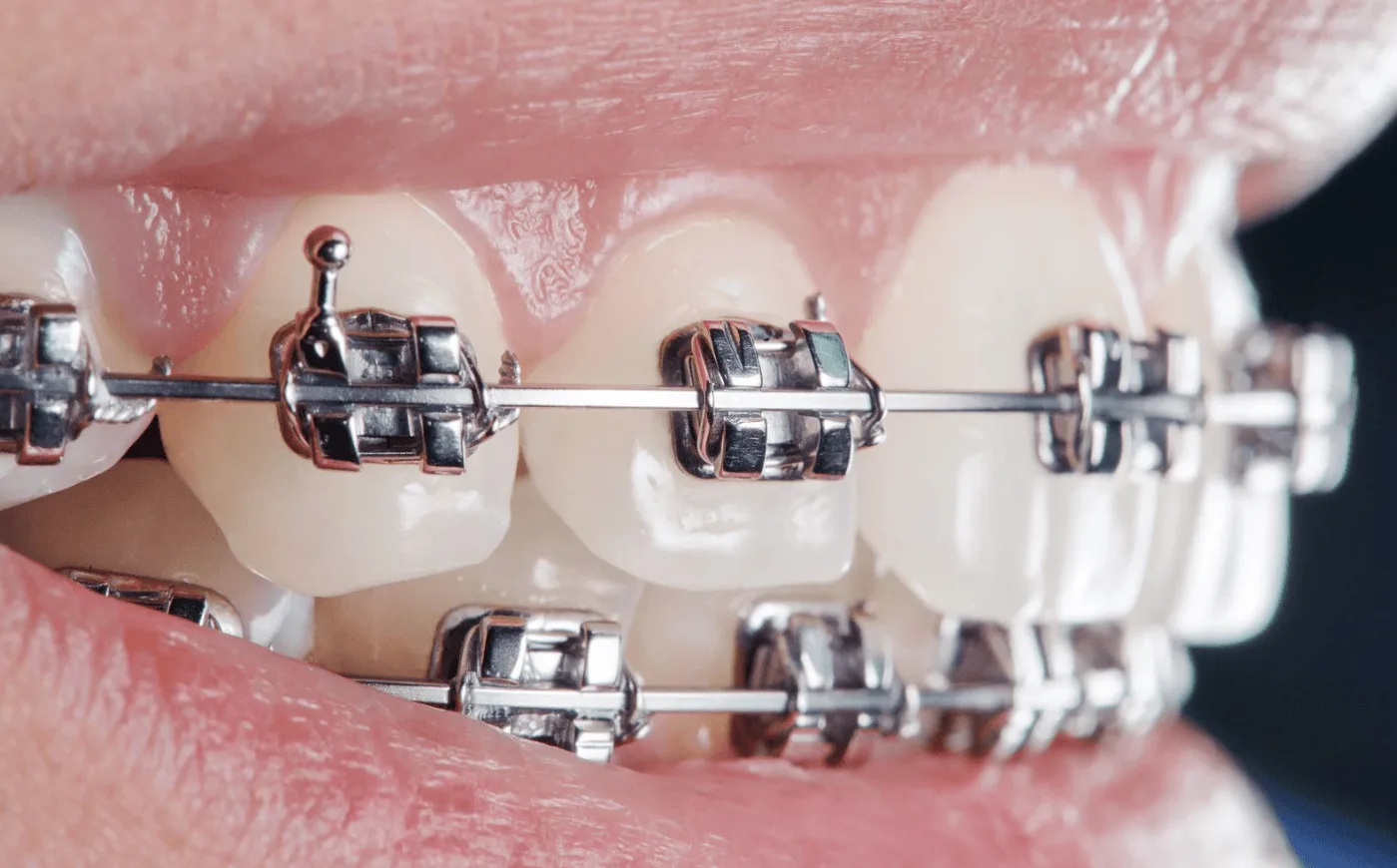 First Orthodontic Visit in New Orleans?