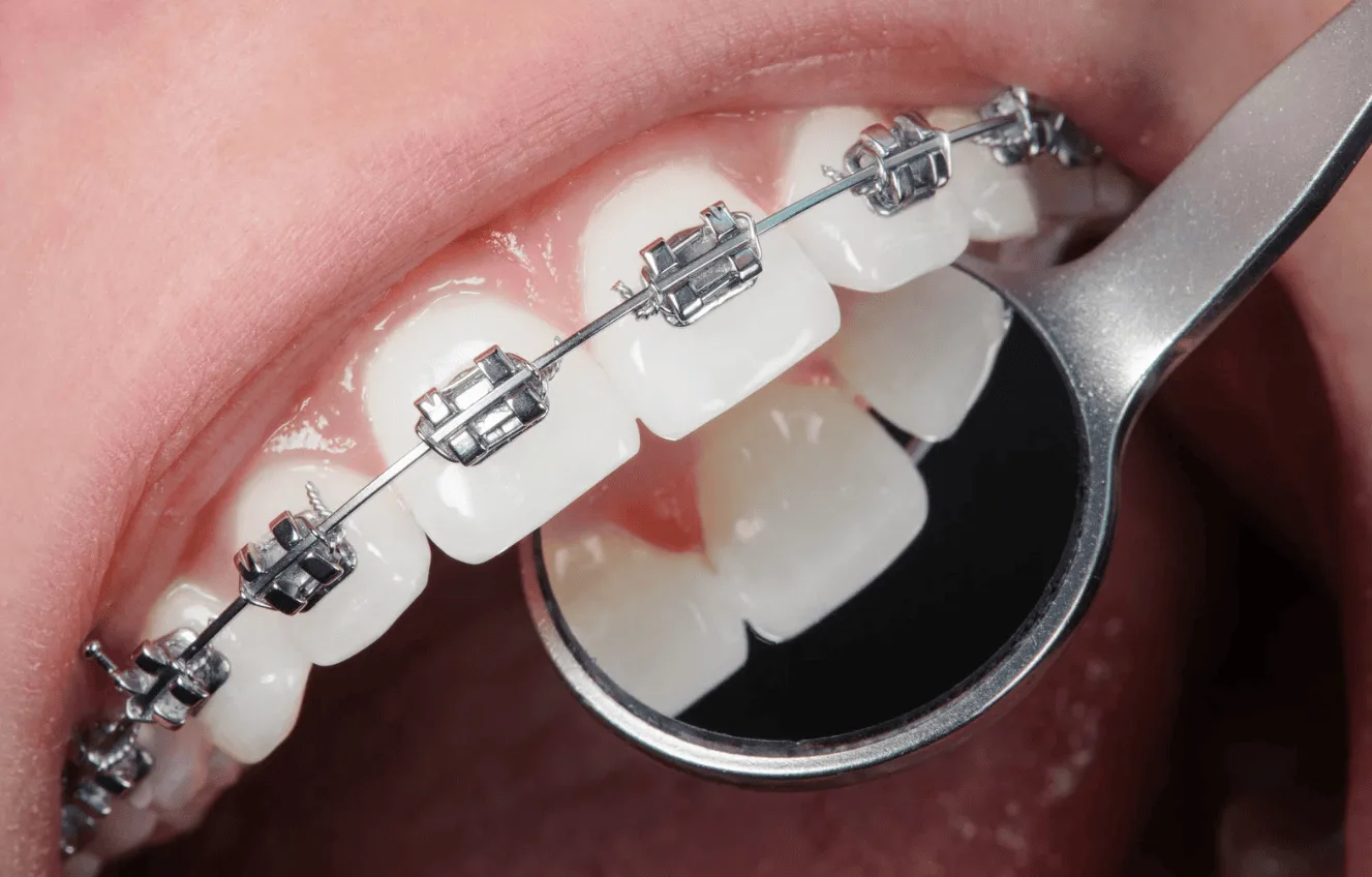Braces in New Orleans
