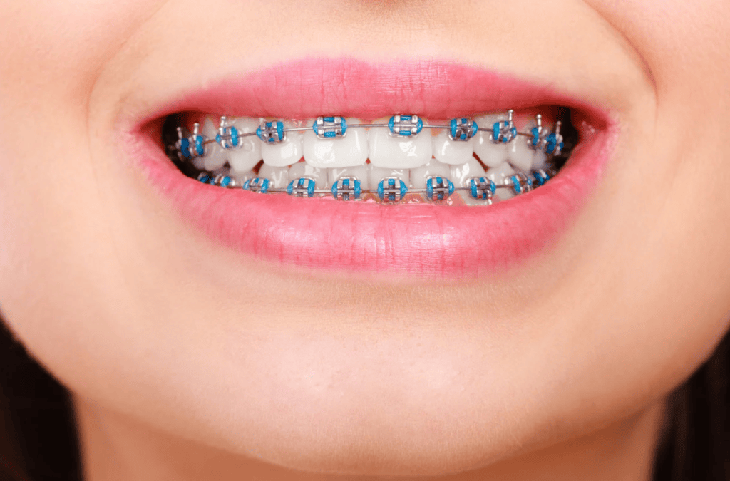 Braces in New Orleans