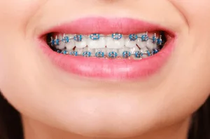 Braces in New Orleans