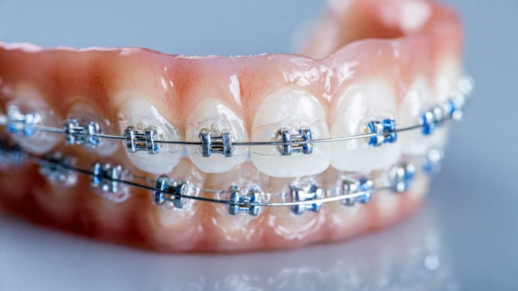 braces_cost_in_new_orleans_vs_new