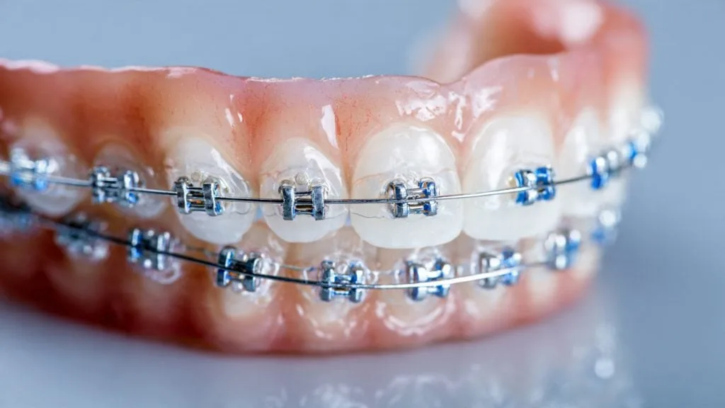 braces_cost_in_new_orleans_vs_new