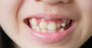 crooked teeth