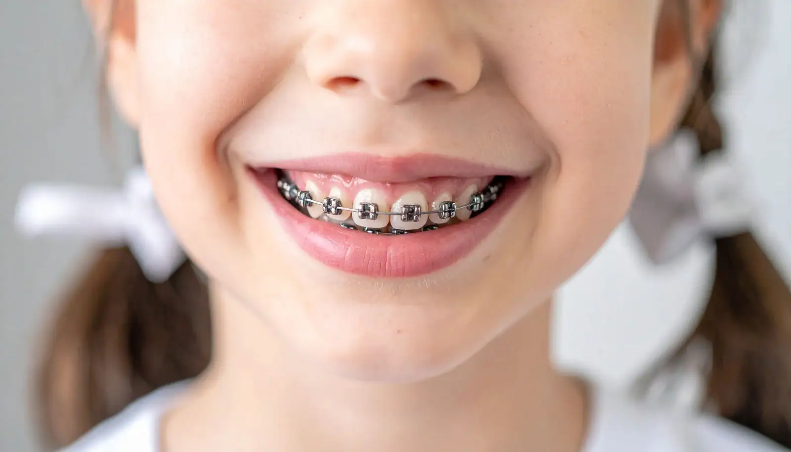 5 Common Myths About Braces You Should Stop Believing!