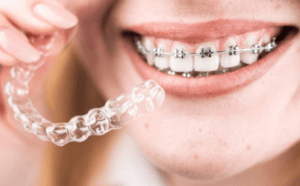 Braces and Invisalign
