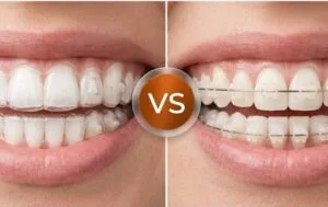 Invisalign and Ceramic Braces (2)