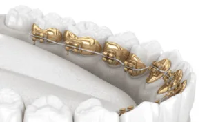 Invisalign and Lingual Braces