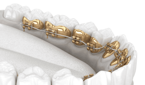 Invisalign and Lingual Braces