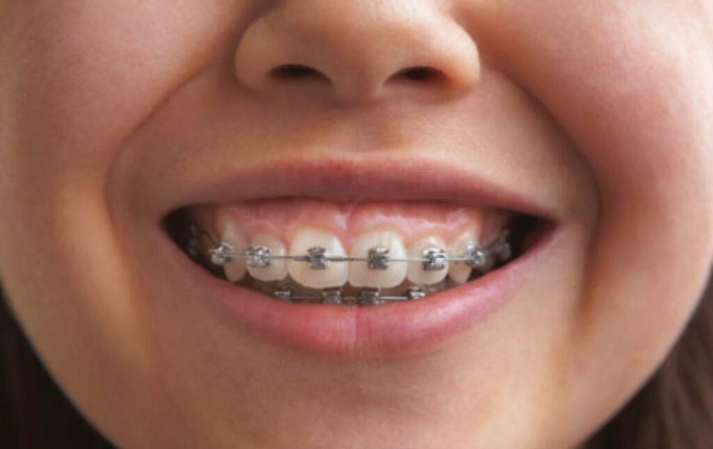 What is the Best Age to Get Braces