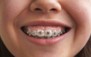 What is the Best Age to Get Braces