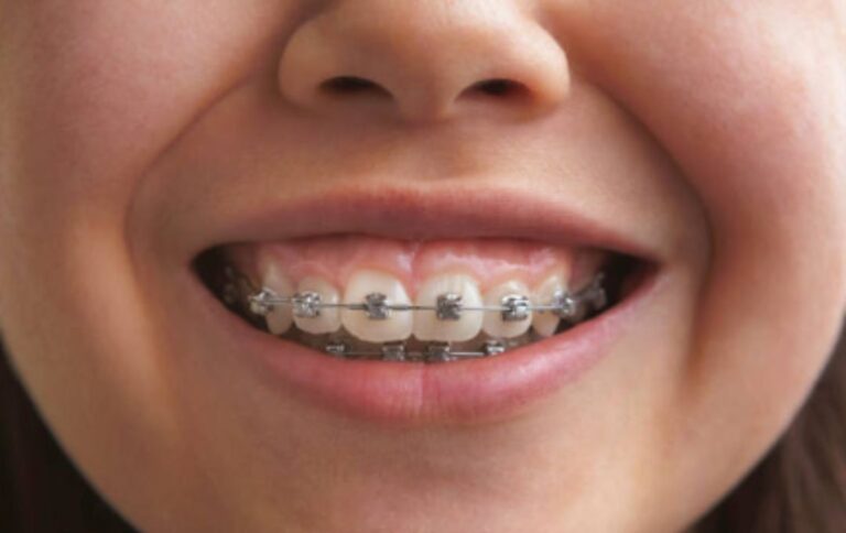 What is the Best Age to Get Braces