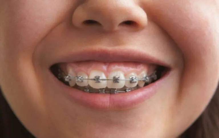 What is the Best Age to Get Braces