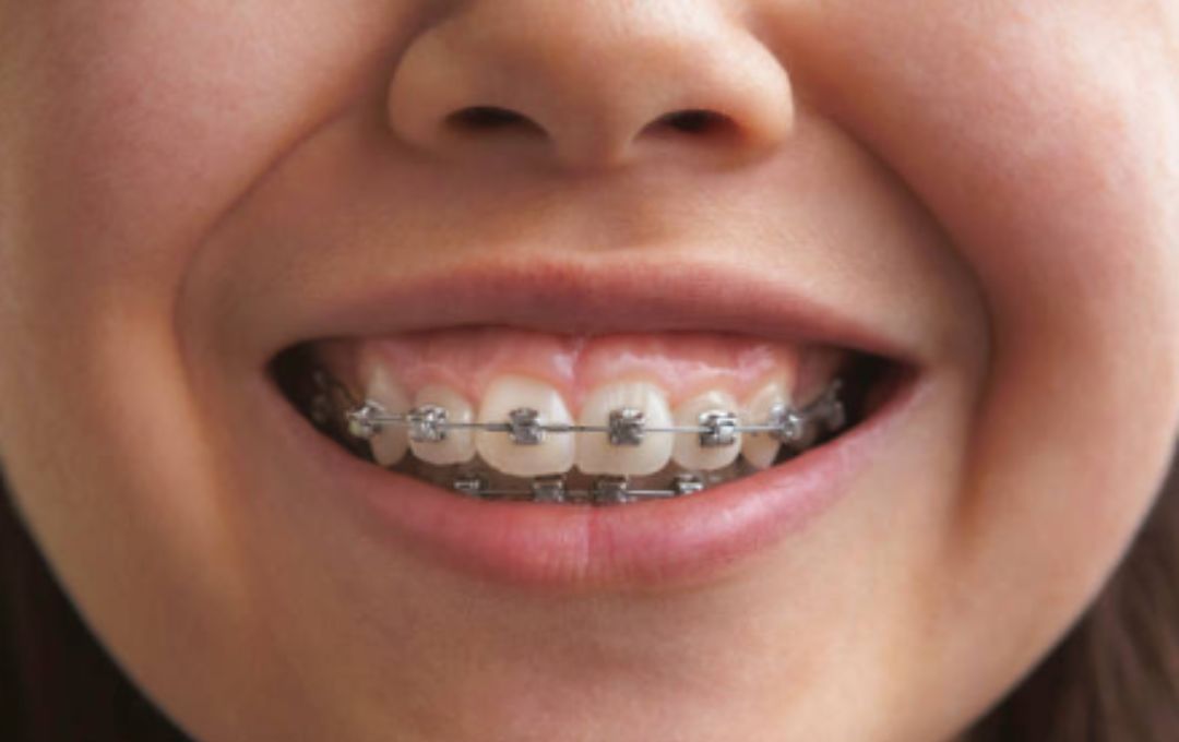 What is the Best Age to Get Braces