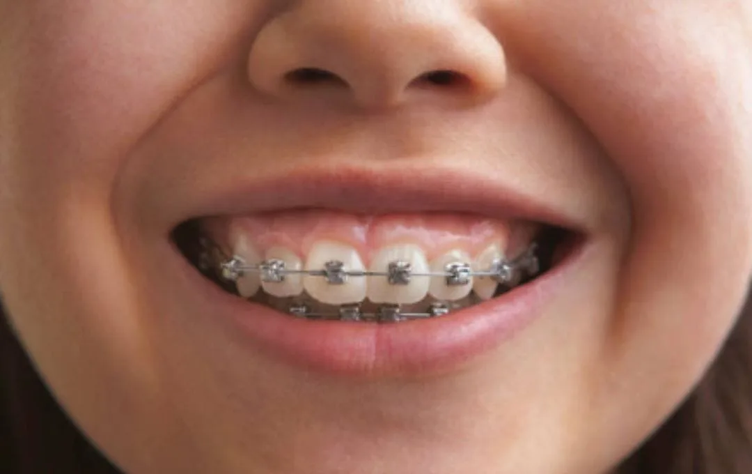 What is the Best Age to Get Braces