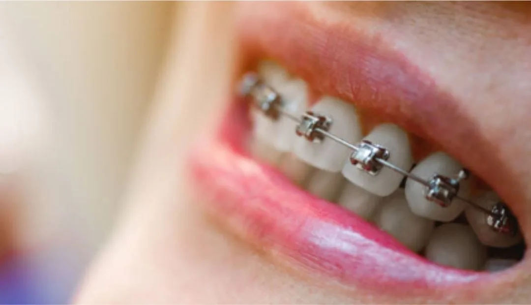 Cost of Braces in Louisiana