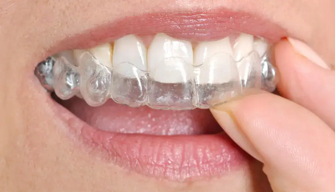 How Long Do You Need to Wear a Retainer After Braces 