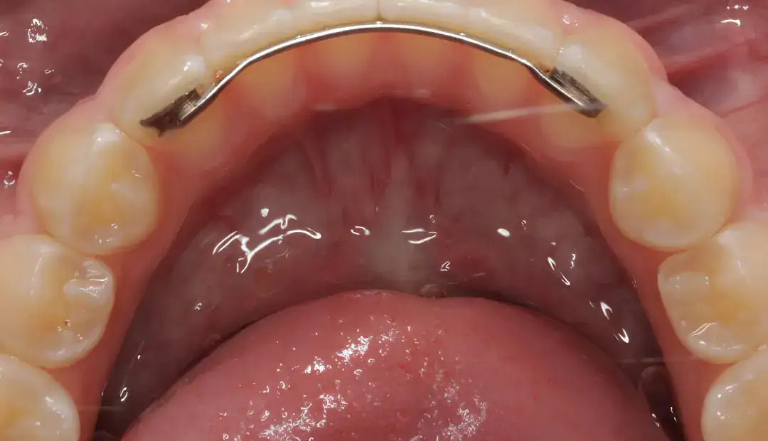 How Long Do You Need to Wear a Retainer After Braces 