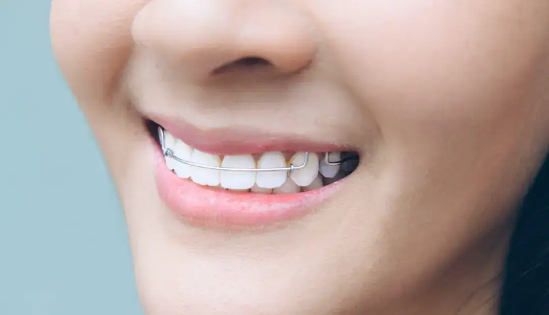 How Long Do You Need to Wear a Retainer After Braces