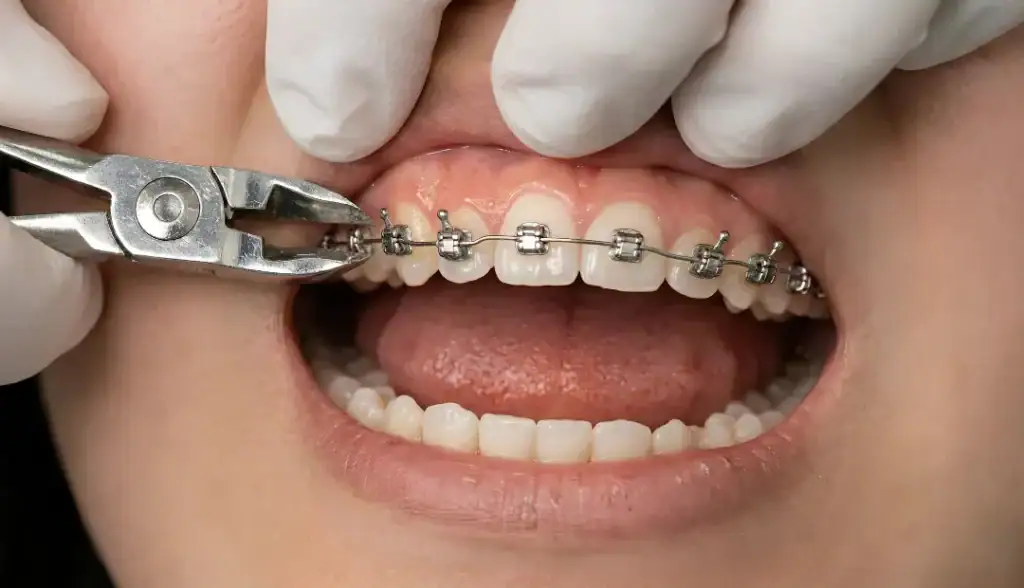 What Happens After Your Braces Come Off