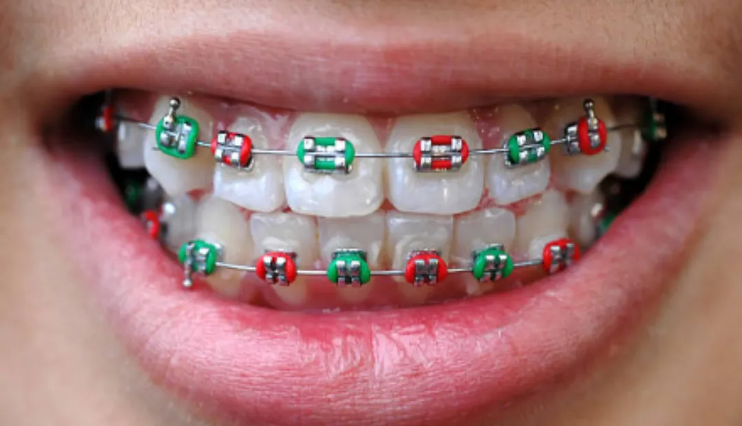 What Happens If Your Teeth Don’t Move as Expected With Braces