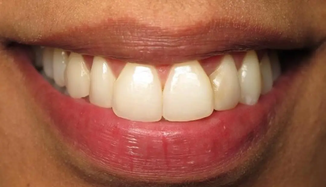 Why Do Teeth Look Bigger After Braces 