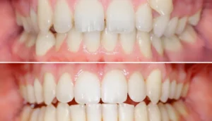 Why Do Teeth Look Bigger After Braces