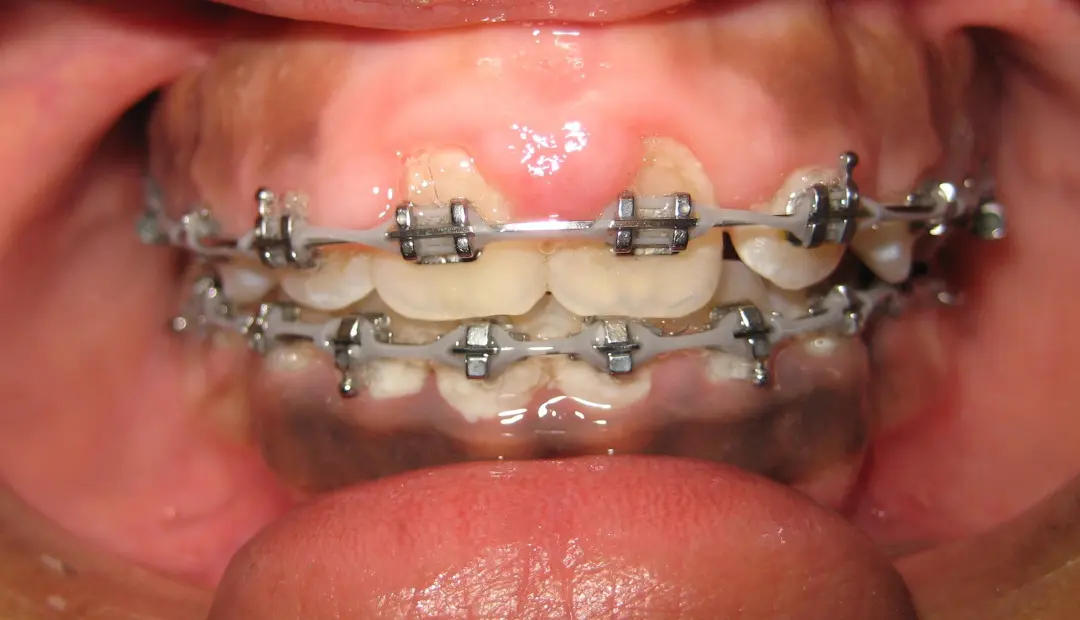 Why Do Teeth Look Bigger After Braces 