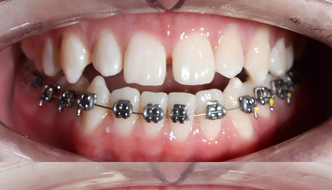 Why Do Teeth Look Bigger After Braces 